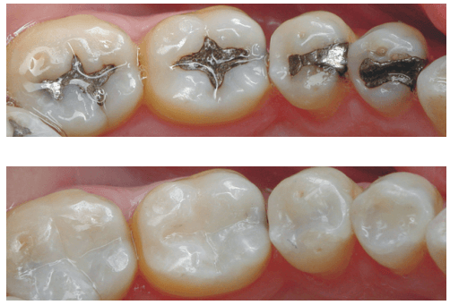 https://cuticul.mn/wp-content/uploads/2022/09/Composite-Fillings.png