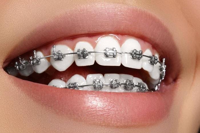 Metal-brace-to-align-and-straighten-crowded-teeth-min.jpg