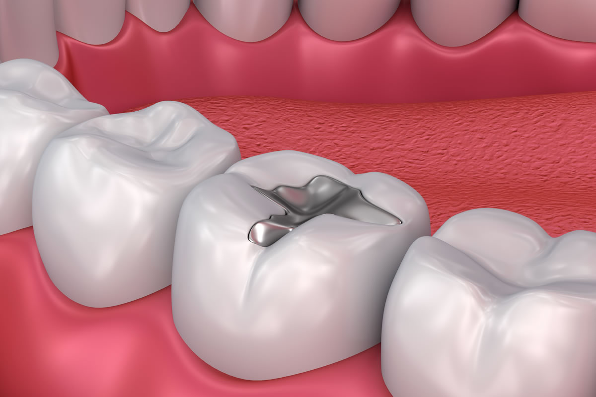 dental-fillings.jpg