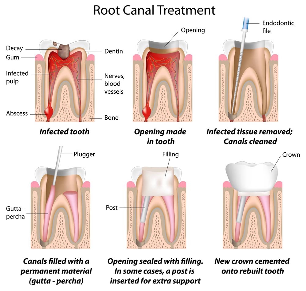 root-canal-treatment-illustration-994f64.jpg
