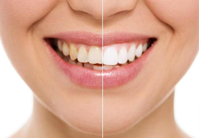 teeth-whitening-2.jpg